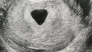 Lire la suite à propos de l’article L&rsquo;œuf clair : comment savoir si nous faisons une grossesse anembryonnaire